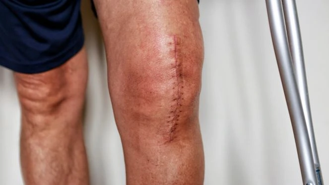 Physiotherapy Helps After Knee Replacement Surgery